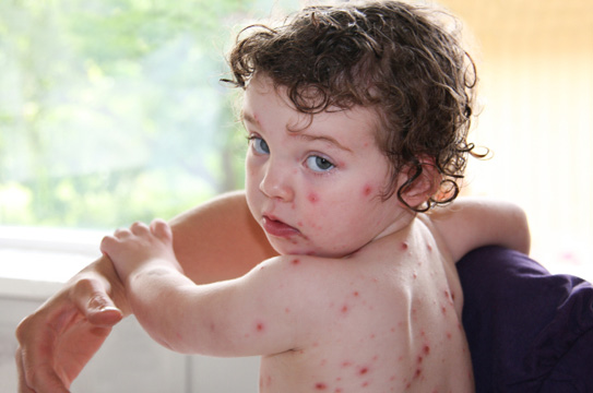 A baby with a rash on the back and face.